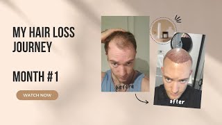 Hair Transplant Full Month HLC Clinic Turkey Review [upl. by Blondie]