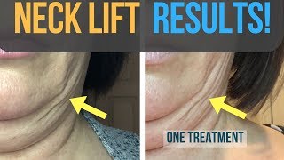 Results From My Fibroblast Plasma Neck Lift [upl. by Scarface]