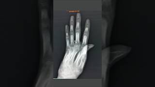 Xray Lt hand ap lateral view of a disable man anatomy xraytechnician doctor xrayinspection [upl. by Larianna]