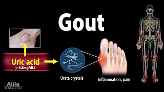 Gout Pathophysiology Causes Symptoms Risk Factors Diagnosis and Treatments Animation [upl. by Romo]