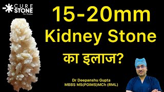 1520mm Kidney Stone का इलाज कैसे होता है Treatment for 1520 mm Kidney stones In Hindi [upl. by Karlyn210]