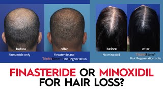 Which is Better Minoxidil or Finasteride for Hair Loss [upl. by Nihhi]