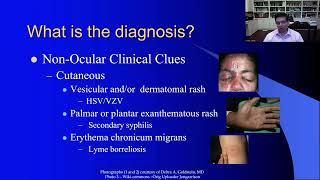 Lecture Uveitis Therapeutics Update [upl. by Newhall]