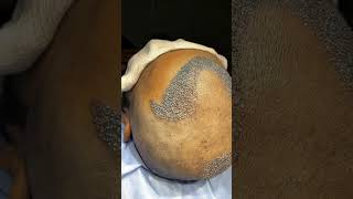 Hair transplant postop Hairline and Crown transformation vincihairclinic shorts [upl. by Sanson]