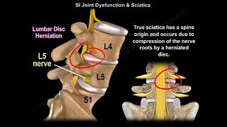 Sacroiliac join dysfunction [upl. by Ronyar28]