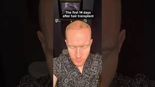 Hair Transplant Results What Happens in the First 14 Days Shocking [upl. by Sandro]