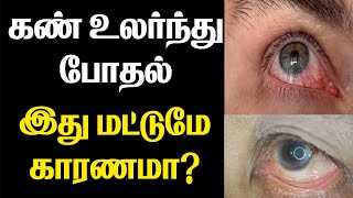 Dry Eye  கண் உலர்ந்து போதல் என்றல் என்ன  கண்பார்வைக்கு ஆபத்தா  கண் இரத்த ஓட்டம் தடைபடுமா [upl. by Rie345]