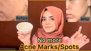 How To Remove Acne Marks Or Spots  Best Easy Home Remedy For Acne  Dietitian Aqsa [upl. by Carlie484]