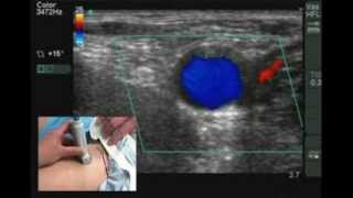 Ultrasound guided Nerve block and Cannulation  Tutorial [upl. by Norra]