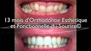 Sourire gingival adulte  correction en 13 mois par aligneurs® en OEFS© [upl. by Strage]