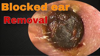 Blocked Ear of A 5 Year Old Child  Doctor Anh [upl. by Artsa342]