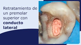 Retratamiento de un premolar superior con conducto lateral [upl. by Aleina]