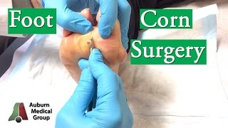 Foot Corn Surgery Treatment [upl. by Cherri]