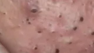 Huge Acne Pimples Blackheads Popping Up Satisfying with Oddly Calm Music Part One [upl. by Adaminah220]