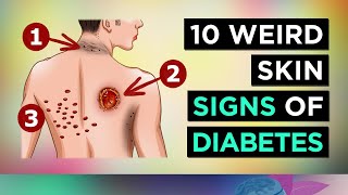 10 Weird SKIN SIGNS of DIABETES [upl. by Amsed]