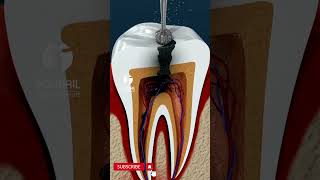 Root Canal Treatment [upl. by Ggerk]