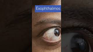 Exophthalmos imwell Exophthalmos [upl. by Netloc]