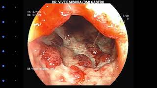 Chronic Ulcerative Colitis  Colonoscopy [upl. by Corena]