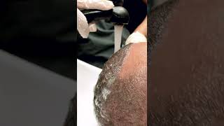 Hair Transplant Day 10 Safe Scab Shedding for a Healthier Recovery hwtclinic asmrvideo [upl. by Posehn266]