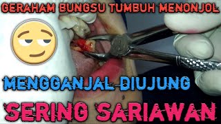 Pencabutan geraham bungsu atas yang tumbuh sangat menonjol [upl. by Annehcu770]