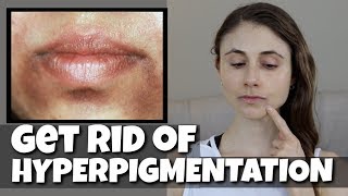 Best Lip Treatment for Angular Cheilitis [upl. by Enialehs797]