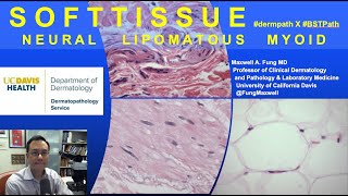 DERMATOPATHOLOGY Soft Tissue Tumors Neural Lipomatous Myoid [upl. by Muhammad]