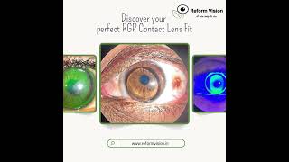 Keratoconus  RGP Contact lenses  Reform Vision  Hyderabad  Dr Reekham Lal [upl. by Dde]