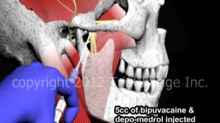 Bupivacaine Anesthesia of the Temperomandibular Joint TMJ  Animation by Cal Shipley MD [upl. by Durham]