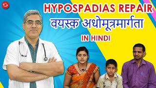 Hypospadias  Hypospadias Repair  वयस्क अधोमूत्रमार्गता पर पूरी जानकारी  Dr Nagwani  India [upl. by Ander930]