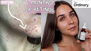 RETINOL CLEARED MY ACNE  BEFORE amp AFTER  6 months update  THE ORDINARY [upl. by Onairam]