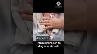 Transillumination to diagnose air leak l Pneumothorax neonatology [upl. by Merrie]