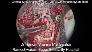 Unedited Cortical Mastoidectomy with Type 1 Tympanoplasty  Repair of Ear Drum  Ear Surgery [upl. by Kerwin]