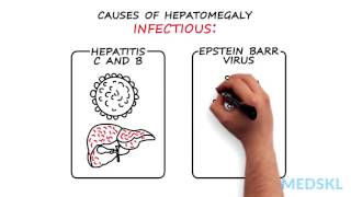 Gastroenterology – Hepatomegaly By Kelly Burak MD [upl. by Samuele]