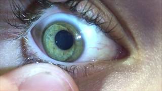 Pose lentille rigide et retrait Adaptation lentille rigide [upl. by Atel]