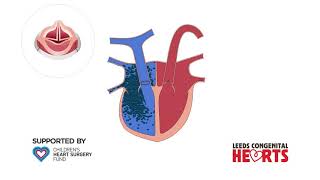 Pulmonary Incompetence amp Pulmonary Valve Replacement [upl. by Holzman]