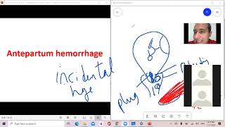 د السكري antepartum hemorrhage APH [upl. by Iliam933]