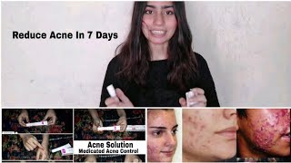 Honest Review On Acdermin Gel  Acdermin Gel Is Used To Treat Acne  Openpores Blackheads Whiteheads [upl. by Biegel]