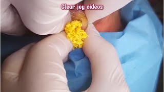 Big Cystic Acne Blackheads Extraction Blackheads amp Milia Whiteheads Removal Pimple Popping [upl. by Rhiana161]