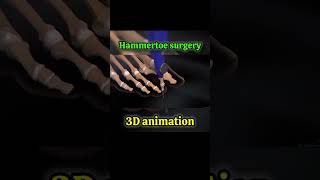 Hammertoe surgery [upl. by Odlopoel]