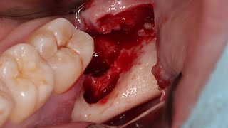 Dicas sobre cirurgia de terceiro molar inferior [upl. by Lokin]