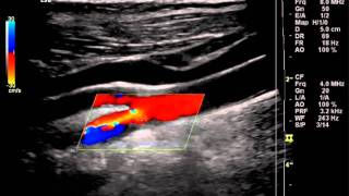 Carotid Doppler with Plaque Ulcer [upl. by Vharat]