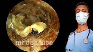 🔴Doctor’s Powerful Ear cholesteatoma Removal Witness the Magicearearwax earwaxremovalasmr [upl. by Milone]