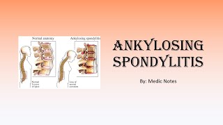 Ankylosing spondylitis  signs and symptoms Schober test Faber test imaging treatment [upl. by Mushro]