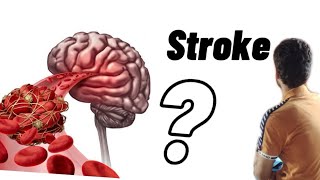 Stroke  Ischemic and Hemorrhagic [upl. by Attennek876]