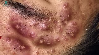 Big Cystic Acne Blackheads Extraction Blackheads amp Milia Whiteheads Removal Pimple Popping [upl. by Yelrak]