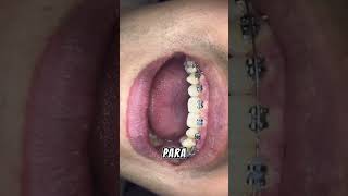 Tipos de Ligadura en Ortodoncia Brackets Ortodoncia Dentista [upl. by Hsilgne]