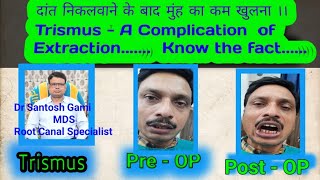 दांत निकलवाने के बाद मुंह का कम खुलना ।। Trismus  A Complication of Extraction Know the fact [upl. by Butler]