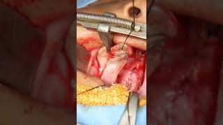 Cleft palate for Speech Surgery [upl. by Neerroc322]