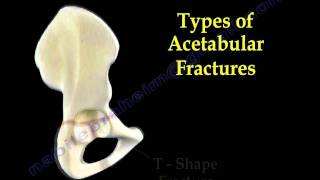 Acetabular Fractures  Everything You Need To Know  Dr Nabil Ebraheim [upl. by Huebner480]