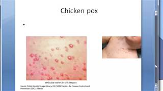 Microbiology 457 a Chicken pox VZV Varicella Zoster HHV3 Virus Difference Shingles [upl. by Spatola]